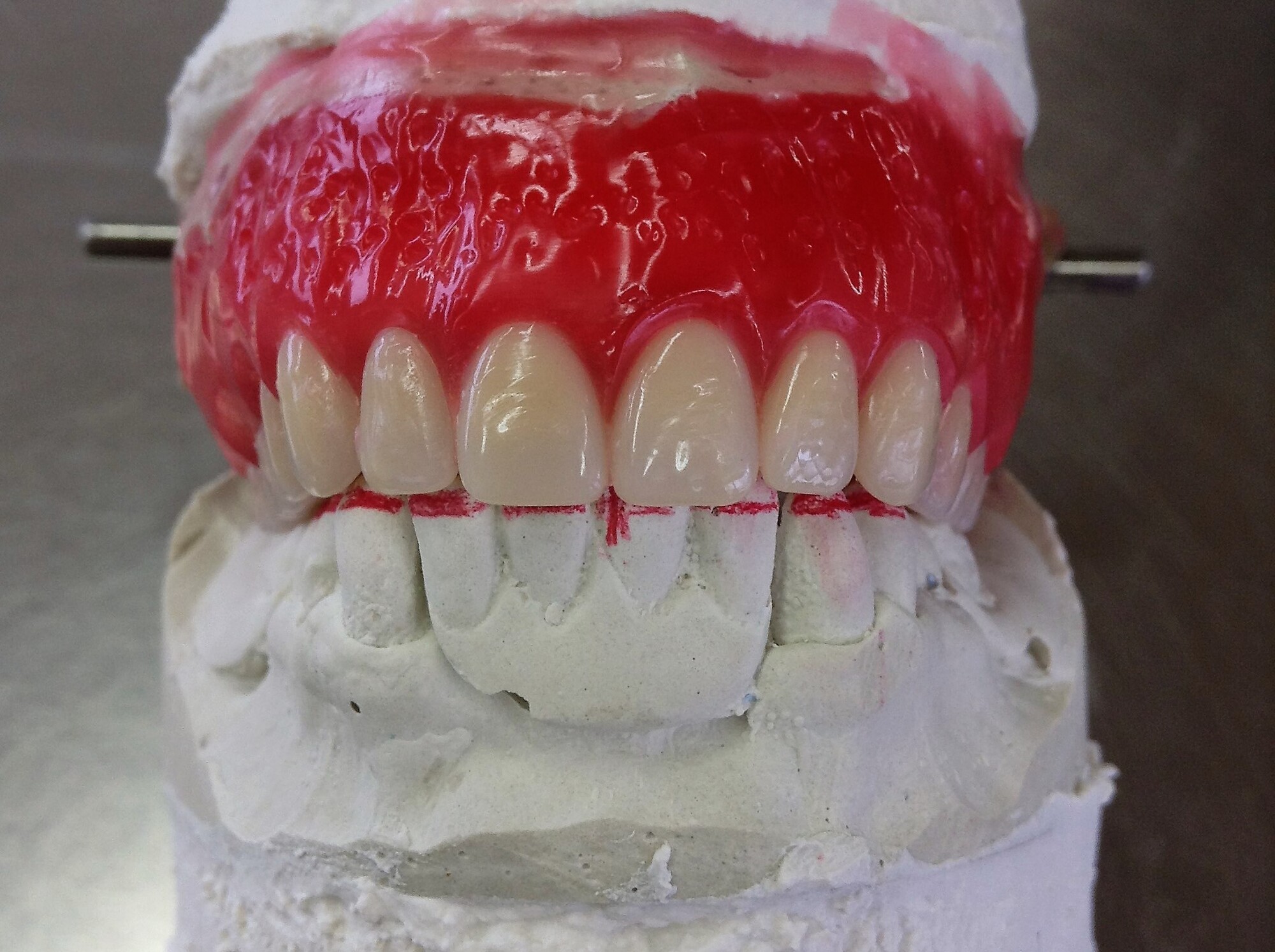 Prothèses Dentaires Temporaires,Dentier Provisoire,Couvre Dents,Fau